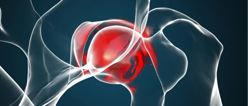 Замена тазобедренного сустава: реабилитация и восстановление