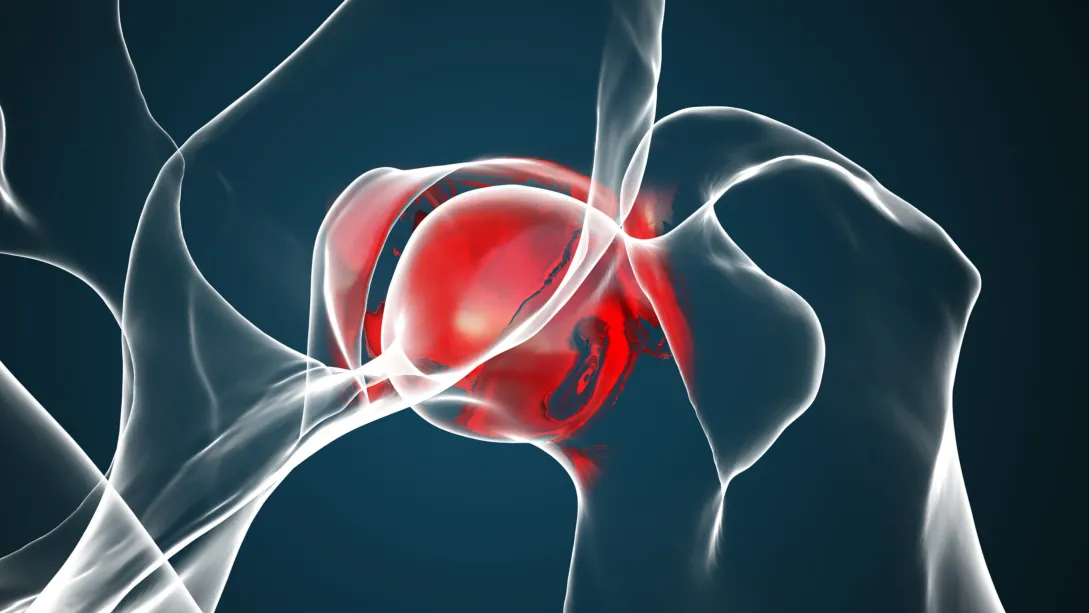 Замена тазобедренного сустава: реабилитация и восстановление