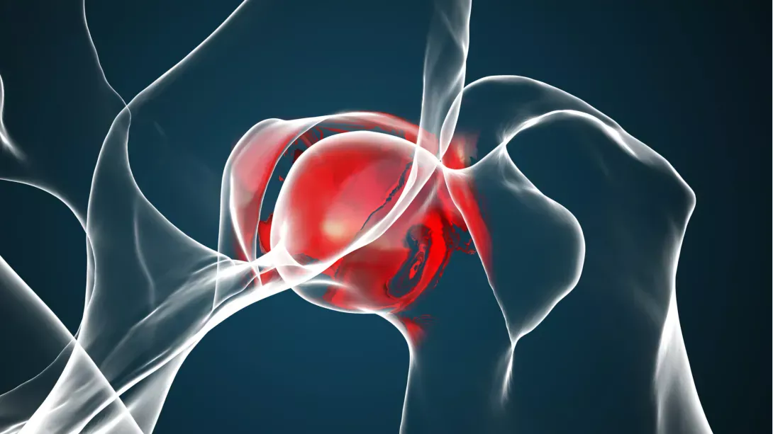 Заміна тазостегнового суглоба: реабілітація та відновлення