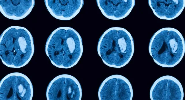 Реабилитация после инсульта: восстановление, уход, профилактика рецидива