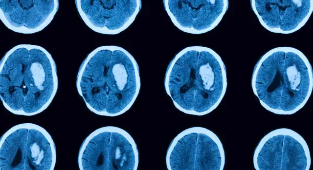 Реабилитация после инсульта: восстановление, уход, профилактика рецидива