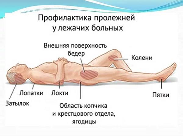 уходе за лежачим больным пролежни