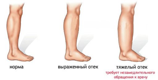Что такое отек ног у пожилых