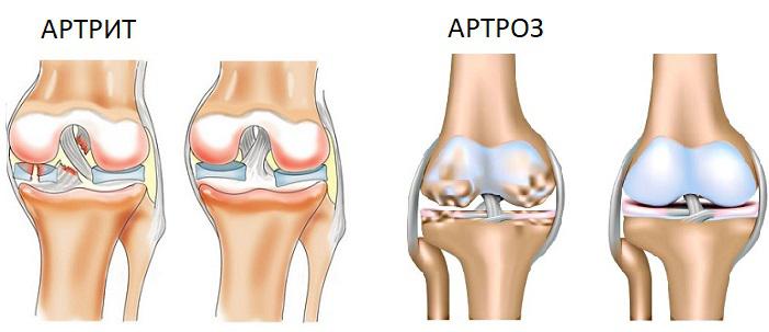Артрит и артроз: симптоматика и причины